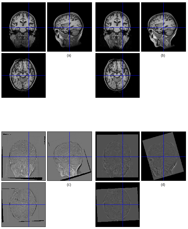 Longitudinal MR Imaging of Alzheimer's Disease — Example